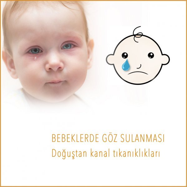Bebeklerde Göz Sulanması / Doğuştan Gözyaşı Kanal Tıkanıklıkları 